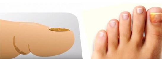 champignon des ongles