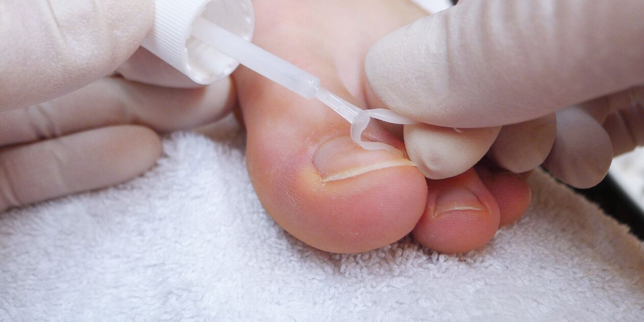 vernis médicinal contre la mycose des ongles