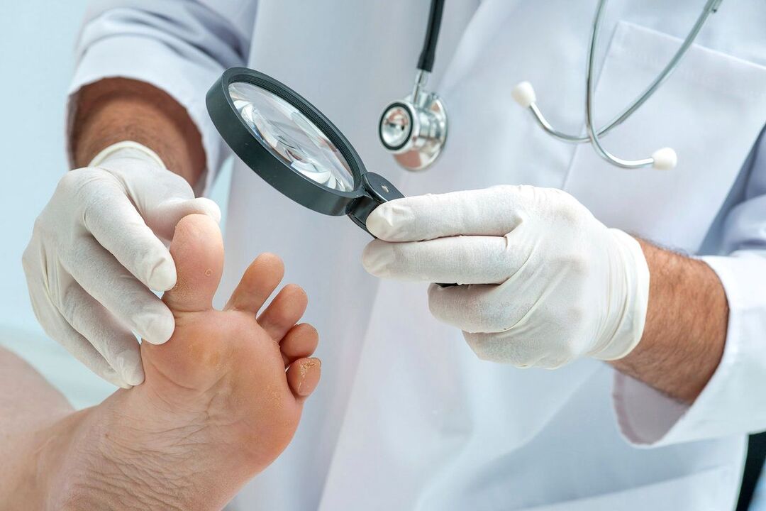 le médecin examine les pieds avec des champignons