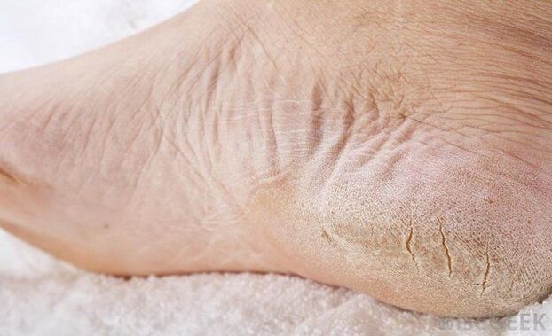 Les pieds secs sont un signe de champignon. 