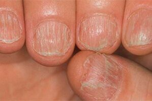 La blessure au champignon
