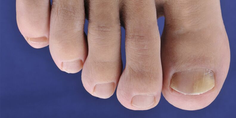 Symptômes de la mycose cutanée et des plaques de ongles