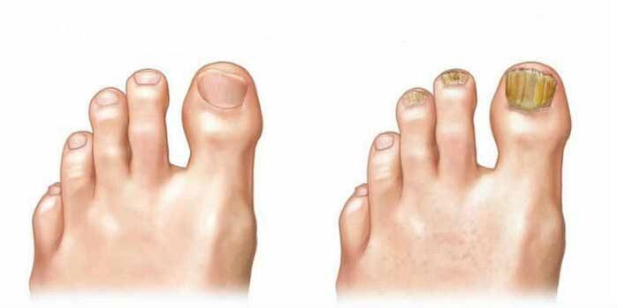 Comment voyez-vous le champignon sur les ongles