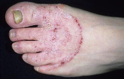 Pieds et champignons à ongles