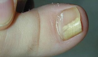 Signes et symptômes de champignon de l'ongle