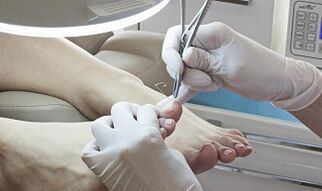 Élimination chirurgicale de l'ongle en présence d'un champignon