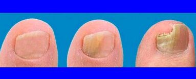 Étapes du développement des champignons sur les doigts des pieds