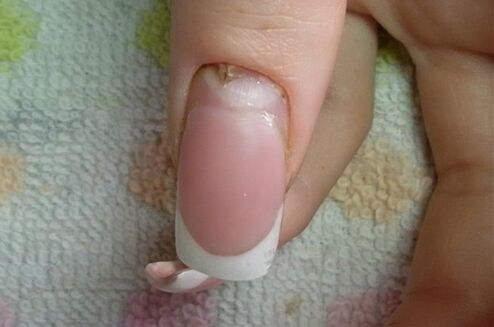 symptômes de mycose des ongles