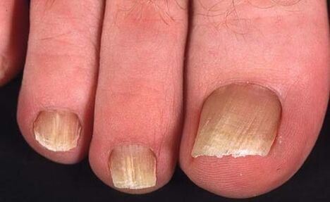 type de champignon des ongles