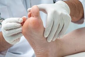 Le médecin examine les pieds à la recherche de champignons sur les orteils.