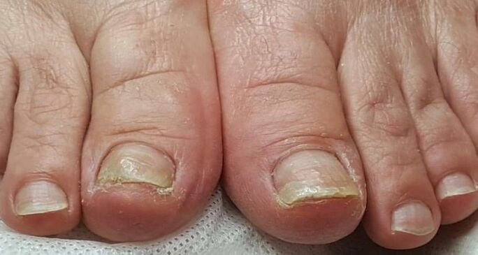 dommages aux ongles avec champignon des orteils